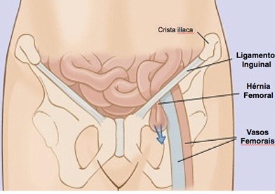 Figura 3 – Hérnia femoral